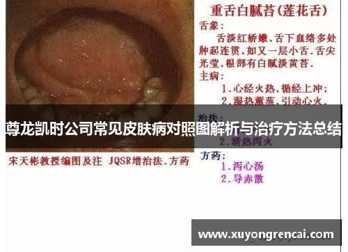 尊龙凯时公司常见皮肤病对照图解析与治疗方法总结